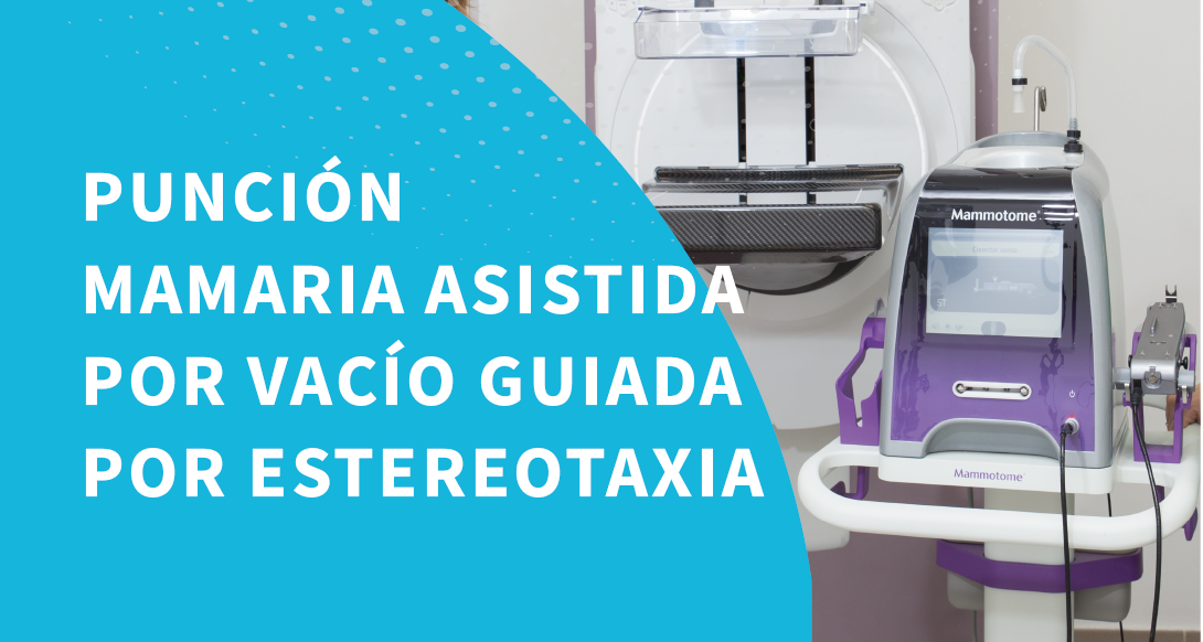 Punción mamaria asistida por vacío guiada por estereotaxia